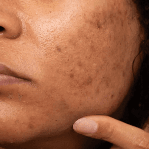 https://storage.tally.so/51208f6a-403b-4522-bd16-c0b903fb3794/Hyper-pigmentation.png