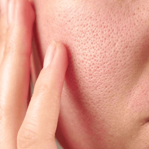 https://storage.tally.so/5c327f4f-f78b-409f-b56c-364768593911/Pores-dilates.png