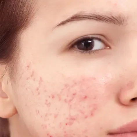 https://storage.tally.so/f7466a6d-ff53-4f42-b07a-d749f49b7fdb/peau-acne.webp